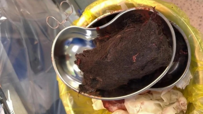 Почти киллограм волос извлекли из желудка 15-летней девочки